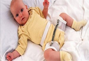 Kalça Çıkığı Belirtileri