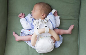 Gelişimsel Kalça Çıkığı