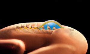 Spina Bifida Neden Olur?